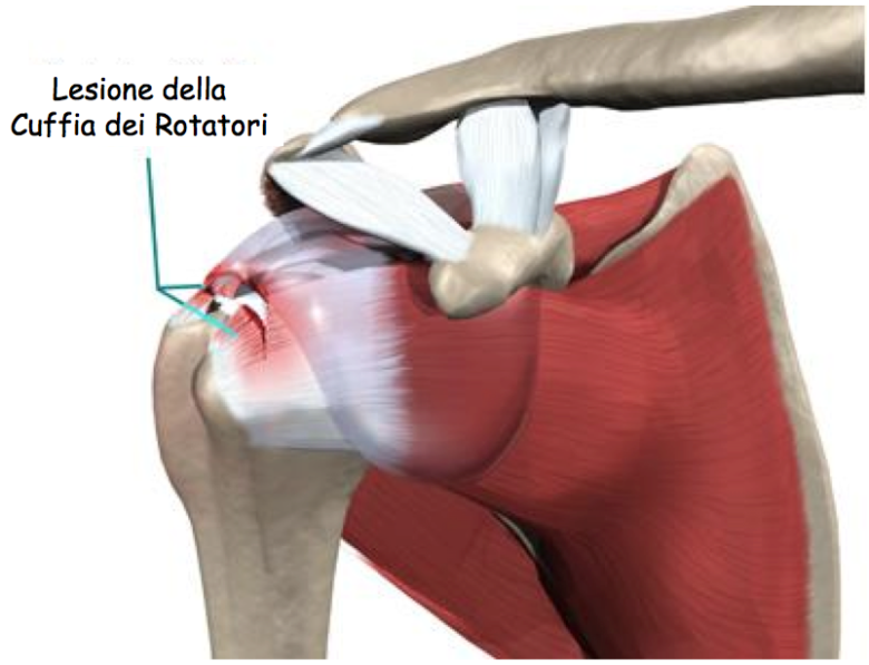 Cuffia dei rotatori